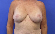 Breast Implant Revision Before Photo by Katerina Gallus, MD, FACS; San Diego, CA - Case 45854