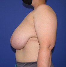 Breast Reduction Before Photo by Katerina Gallus, MD, FACS; San Diego, CA - Case 46425