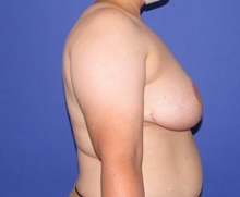Breast Reduction After Photo by Katerina Gallus, MD, FACS; San Diego, CA - Case 46425