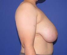 Breast Reduction Before Photo by Katerina Gallus, MD, FACS; San Diego, CA - Case 46425