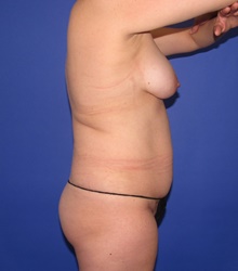 Liposuction Before Photo by Katerina Gallus, MD, FACS; San Diego, CA - Case 46428