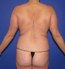Liposuction Before Photo by Katerina Gallus, MD, FACS; San Diego, CA - Case 46428