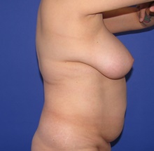 Liposuction Before Photo by Katerina Gallus, MD, FACS; San Diego, CA - Case 46435