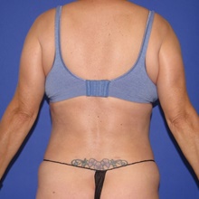 Liposuction After Photo by Katerina Gallus, MD, FACS; San Diego, CA - Case 46435