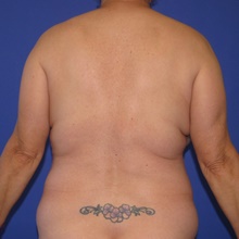 Liposuction Before Photo by Katerina Gallus, MD, FACS; San Diego, CA - Case 46435