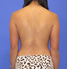 Breast Implant Revision Before Photo by Katerina Gallus, MD, FACS; San Diego, CA - Case 47078