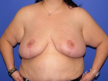 Breast Lift After Photo by Katerina Gallus, MD, FACS; San Diego, CA - Case 47111