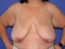 Breast Lift Before Photo by Katerina Gallus, MD, FACS; San Diego, CA - Case 47111