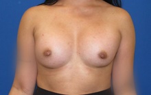Breast Augmentation After Photo by Katerina Gallus, MD, FACS; San Diego, CA - Case 47113