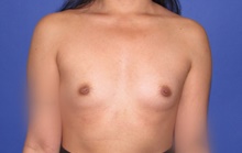 Breast Augmentation Before Photo by Katerina Gallus, MD, FACS; San Diego, CA - Case 47113