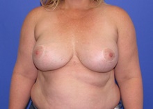 Breast Augmentation After Photo by Katerina Gallus, MD, FACS; San Diego, CA - Case 47388