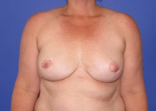 Breast Augmentation Before Photo by Katerina Gallus, MD, FACS; San Diego, CA - Case 47388