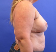 Breast Augmentation After Photo by Katerina Gallus, MD, FACS; San Diego, CA - Case 47388