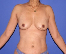 Breast Implant Removal After Photo by Katerina Gallus, MD, FACS; San Diego, CA - Case 47389
