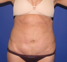 Tummy Tuck After Photo by Katerina Gallus, MD, FACS; San Diego, CA - Case 47392