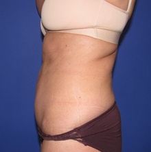 Tummy Tuck After Photo by Katerina Gallus, MD, FACS; San Diego, CA - Case 47392