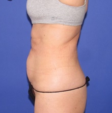 Tummy Tuck Before Photo by Katerina Gallus, MD, FACS; San Diego, CA - Case 47392