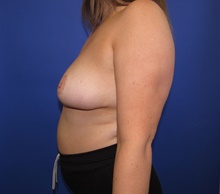 Breast Reduction After Photo by Katerina Gallus, MD, FACS; San Diego, CA - Case 47393