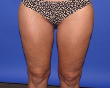 Thigh Lift After Photo by Katerina Gallus, MD, FACS; San Diego, CA - Case 47400