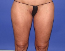 Thigh Lift Before Photo by Katerina Gallus, MD, FACS; San Diego, CA - Case 47400