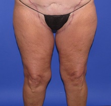 Thigh Lift After Photo by Katerina Gallus, MD, FACS; San Diego, CA - Case 47402