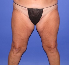 Thigh Lift Before Photo by Katerina Gallus, MD, FACS; San Diego, CA - Case 47402
