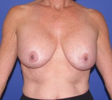 Breast Implant Removal Before Photo by Katerina Gallus, MD, FACS; San Diego, CA - Case 47403