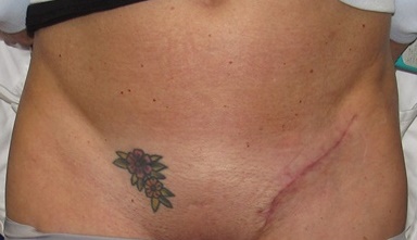 Cosmetic Dermatology Tattoo Removal in Chula Vista & Coronado, CA |  Dermatology Institute