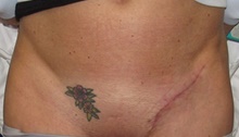 Tattoo Removal After Photo by Katerina Gallus, MD, FACS; San Diego, CA - Case 47404