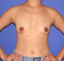 Breast Augmentation Before Photo by Katerina Gallus, MD, FACS; San Diego, CA - Case 47407
