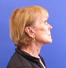 Facelift After Photo by Katerina Gallus, MD, FACS; San Diego, CA - Case 47408