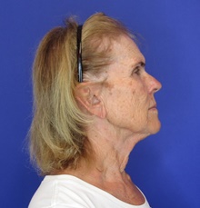 Facelift Before Photo by Katerina Gallus, MD, FACS; San Diego, CA - Case 47408