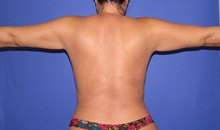 Liposuction Before Photo by Katerina Gallus, MD, FACS; San Diego, CA - Case 47410