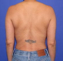 Liposuction After Photo by Katerina Gallus, MD, FACS; San Diego, CA - Case 47412