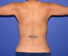 Liposuction Before Photo by Katerina Gallus, MD, FACS; San Diego, CA - Case 47412