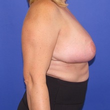 Breast Reduction After Photo by Katerina Gallus, MD, FACS; San Diego, CA - Case 47413