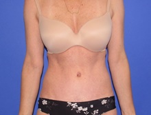 Tummy Tuck After Photo by Katerina Gallus, MD, FACS; San Diego, CA - Case 47531