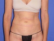 Tummy Tuck Before Photo by Katerina Gallus, MD, FACS; San Diego, CA - Case 47531