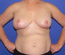 Breast Implant Removal After Photo by Katerina Gallus, MD, FACS; San Diego, CA - Case 47565