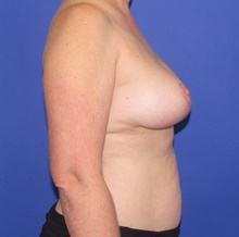 Breast Implant Removal After Photo by Katerina Gallus, MD, FACS; San Diego, CA - Case 47565