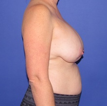 Breast Implant Removal Before Photo by Katerina Gallus, MD, FACS; San Diego, CA - Case 47565