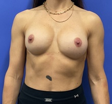 Breast Implant Revision Before Photo by Katerina Gallus, MD, FACS; San Diego, CA - Case 48445
