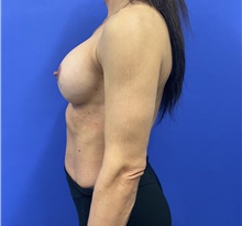 Breast Implant Revision After Photo by Katerina Gallus, MD, FACS; San Diego, CA - Case 48445