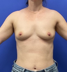 Breast Augmentation Before Photo by Katerina Gallus, MD, FACS; San Diego, CA - Case 48446