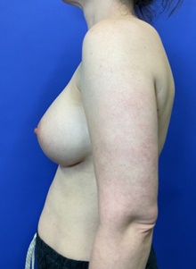 Breast Augmentation After Photo by Katerina Gallus, MD, FACS; San Diego, CA - Case 48446