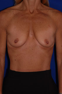 Breast Augmentation Before Photo by Eric Egozi, MD; Clearwater, FL - Case 10413