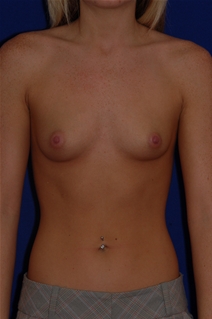 Breast Augmentation Before Photo by Eric Egozi, MD; Clearwater, FL - Case 10482