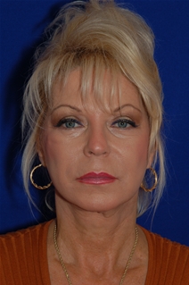 Facelift After Photo by Eric Egozi, MD; Clearwater, FL - Case 22179