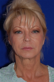 Facelift Before Photo by Eric Egozi, MD; Clearwater, FL - Case 22179