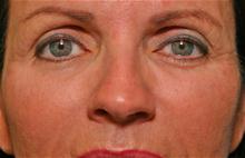 Eyelid Surgery After Photo by Robert Buchanan, MD; Highlands, NC - Case 27172